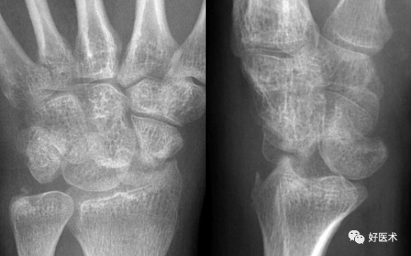 贊！腕關節X線高畫質解剖+腕骨脫位典型病例