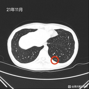 &OpenCurlyDoubleQuote;六年的感情因結節而退縮&rdquo;同行患磨玻璃肺癌心酸求助