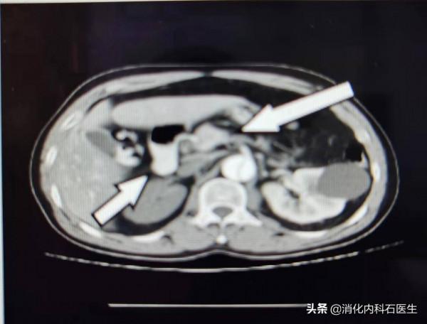 男子腰腹疼，以為結石治療無效，IVP結果一出醫生慌了：腎哪去了