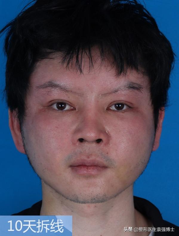 32歲小夥子拉皮真實記錄,術後30天效果很“驚豔” 32歲小夥子拉皮真實記錄,術後30天效果很“驚豔”