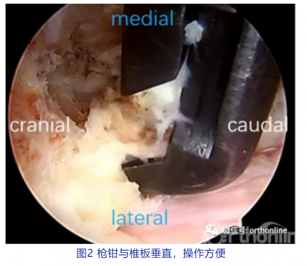 文獻梳理 脊柱後路內鏡治療脊髓型頸椎病