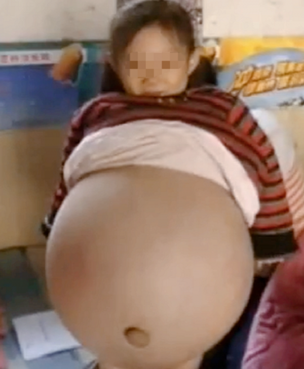 還記得那個得“怪病”肚子大過孕婦的山西女童嗎？後來治好了嗎？