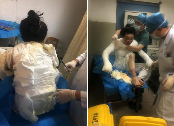 美媽凌晨拔火罐欲解痠痛，不料發生悲劇，從此全身戴上“緊箍咒”