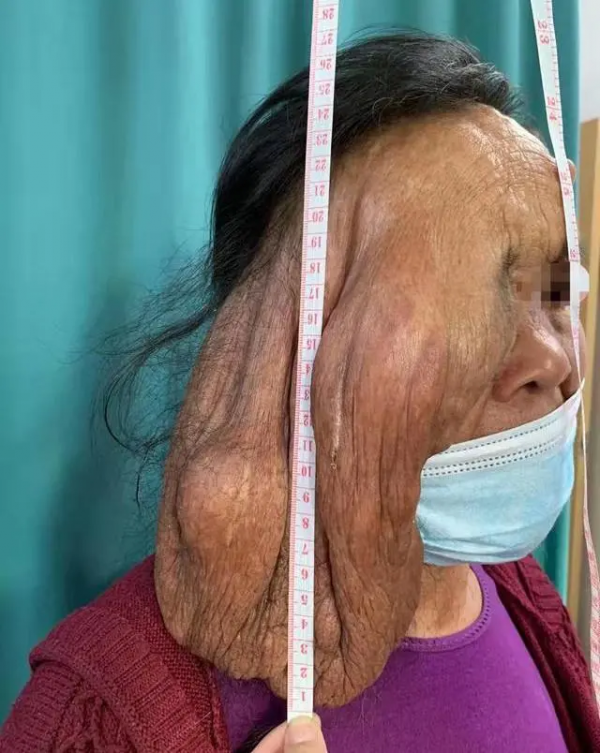 面板猶如“灑上牛奶咖啡”？警惕神經纖維瘤病