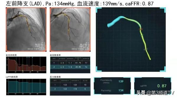 心臟要不要放支架？它“說”了算