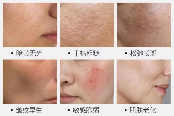 關於光子嫩膚的常見問答 關於光子嫩膚的常見問答