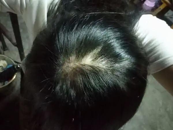 頭上總是長疙瘩，還時不時有膿包？很可能是這4種現象引起的