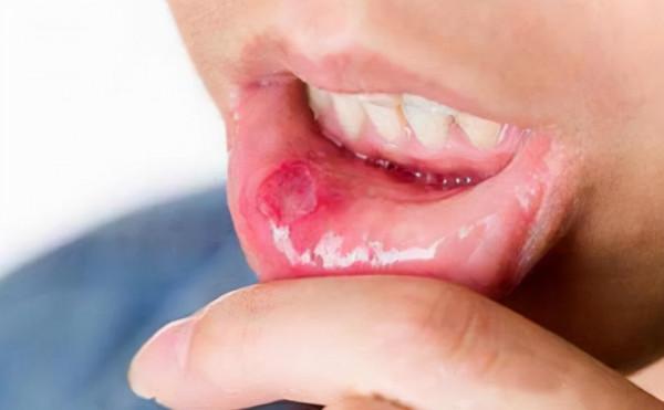 頑固口瘡再犯?有脾胃病史?脾胃氣虛型?該用啥中藥治療?快收藏 頑固口瘡再犯?有脾胃病史?脾胃氣虛型?該用啥中藥治療?快收藏