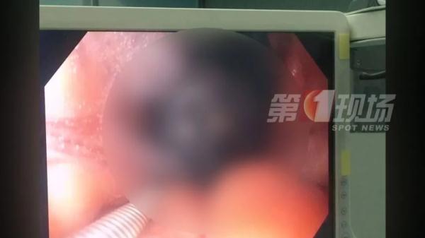 女童腹痛,竟是吃的東西“不尋常”……它們佔了胃部三分之一 女童腹痛,竟是吃的東西“不尋常”……它們佔了胃部三分之一