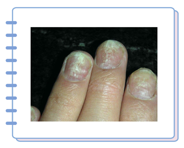 得了灰指甲,反覆發作難根治?一次性介紹7種藥,總有一款適合你 得了灰指甲,反覆發作難根治?一次性介紹7種藥,總有一款適合你