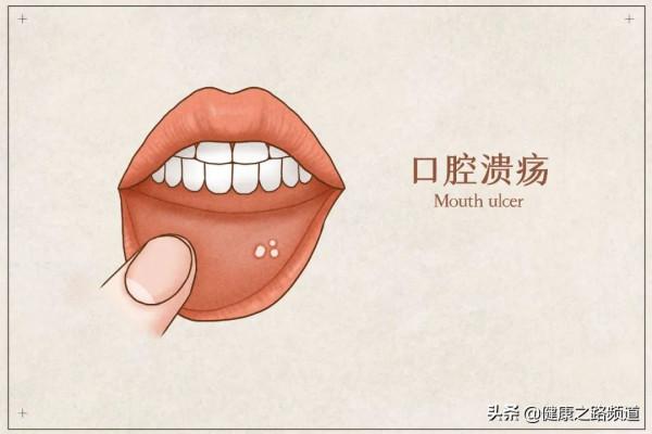 口腔潰瘍容易反覆發作,按揉這兩個穴位,緩解疼痛 口腔潰瘍容易反覆發作,按揉這兩個穴位,緩解疼痛