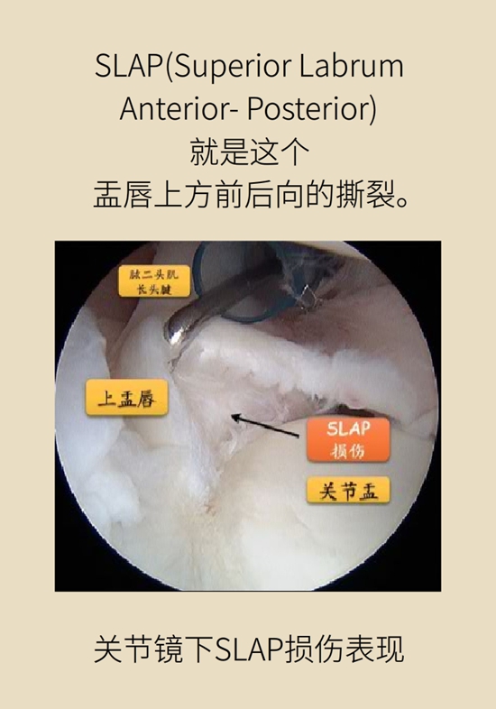 健身房裡最常發生的肩痛，該怎麼應對？