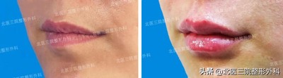 自體脂肪豐唇