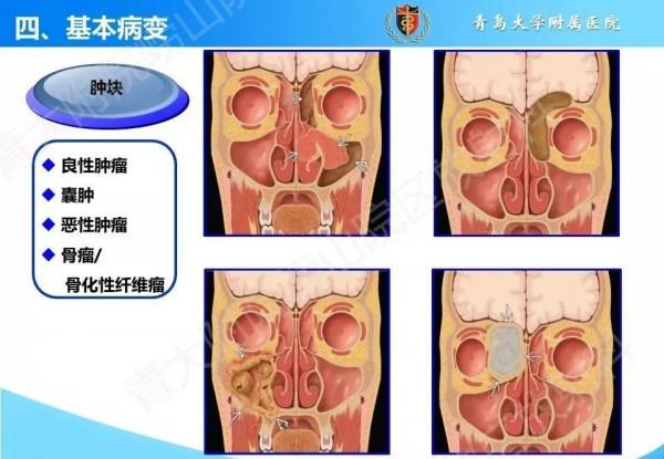 頭頸五官CT斷層解剖圖及常見病影像診斷