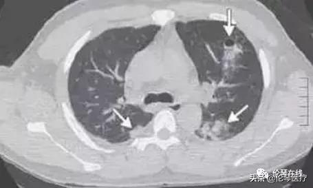 這種吃螃蟹吃出的怪病,影像醫生都是怎麼診斷的?|倫琴醫療 這種吃螃蟹吃出的怪病,影像醫生都是怎麼診斷的?|倫琴醫療