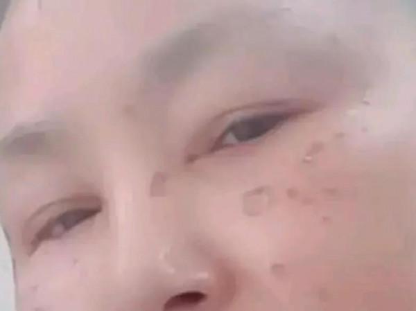 &quot;藥水點斑&quot;究竟好不好？點斑一年以後的我用真實的效果來告訴你