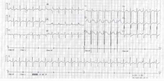 室性心律失常的新進展,你瞭解多少?|GW-ICC 2021 室性心律失常的新進展,你瞭解多少?|GW-ICC 2021