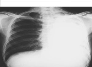 先天性肺氣腫的病因有哪些？