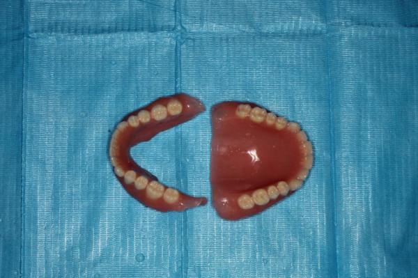 當天搞定,她“長”出滿口新牙 當天搞定,她“長”出滿口新牙