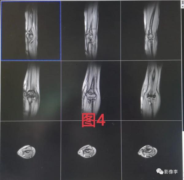 “靜電”與磁共振成像：秋冬季節注意