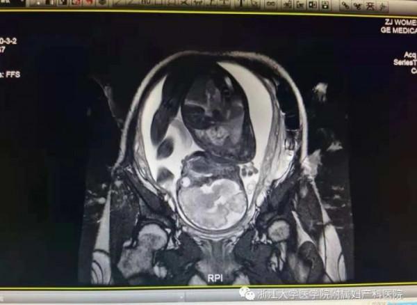 全國首例！差點一腳“踢出”子宮的寶寶，平安降生啦