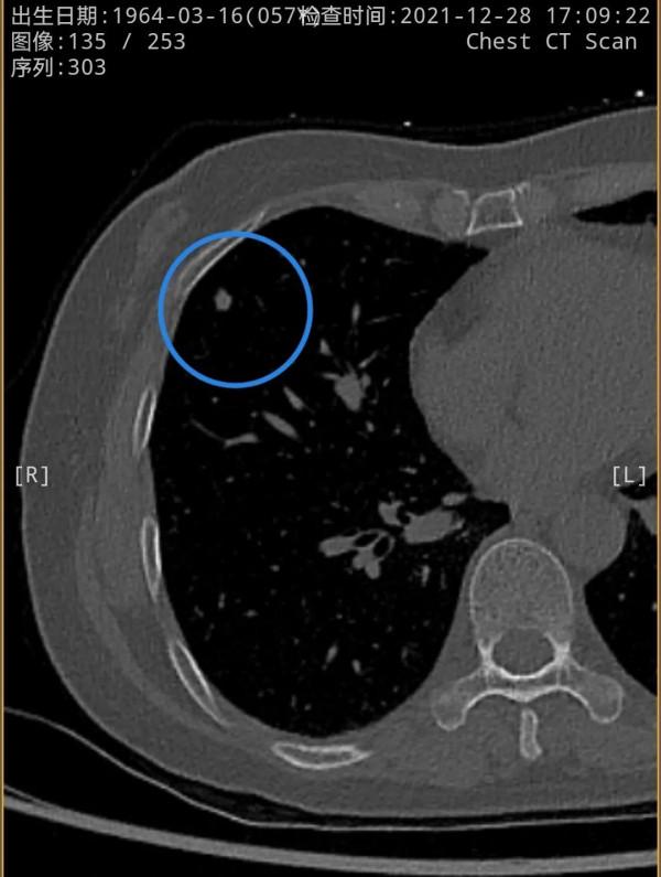右肺多發實性結節2年多了，我們該怎麼看待？