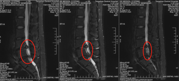 榮譽背後的傷與痛——記一位腰椎間盤突出症運動員