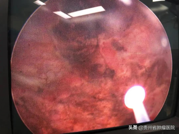 我院泌尿外科成功開展首例膀胱癌光動力治療