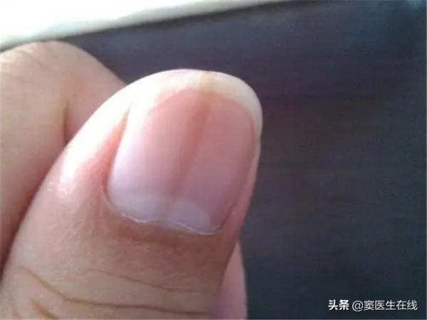 為什麼有的人指甲上有月牙，有的人卻沒有？