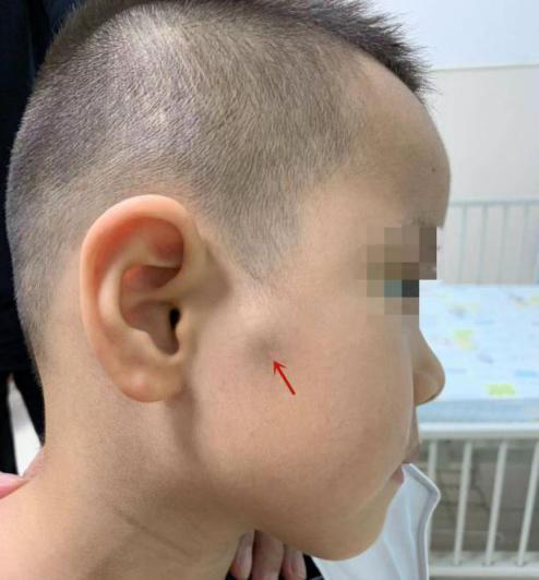 小孩臉上有個“包”，不是蚊子咬，警惕是這種疾病