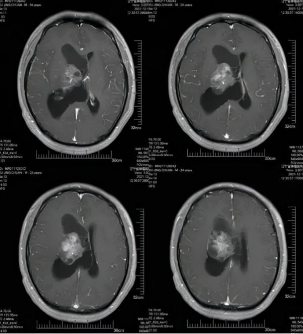 東北地區首例！機器人手術顯微鏡聯合鏡下導航賦能 顯微神經外科手術步入精準切除時代