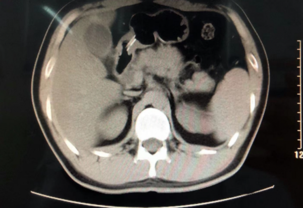 一頓饕餮美食後 小夥竟然腹痛站不起身來,原來是突發急性胰腺炎 一頓饕餮美食後 小夥竟然腹痛站不起身來,原來是突發急性胰腺炎