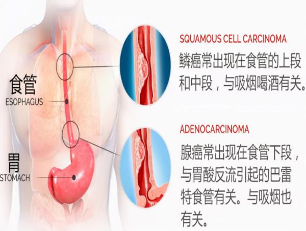 奪走趙忠祥生命的鱗狀細胞癌,聽起來陌生,實際上卻很常見 奪走趙忠祥生命的鱗狀細胞癌,聽起來陌生,實際上卻很常見