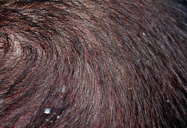 出油、瘙癢？脂溢性皮炎用什麼洗髮水才好？別錯過這1款