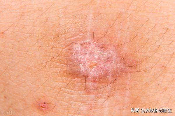 疤痕患者日常注意事項 疤痕患者日常注意事項