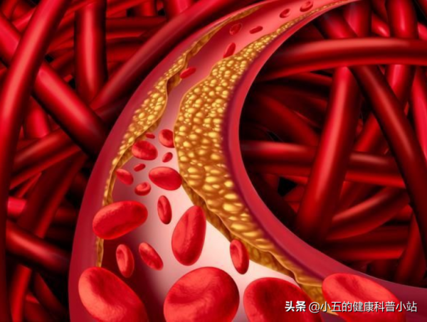 長期糖尿病引起血管損傷怎麼辦？合理使用4種藥物，幫你保護血管