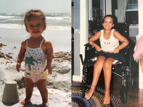 侏儒症患者成功長高30多釐米 分享四肢延長手術經歷