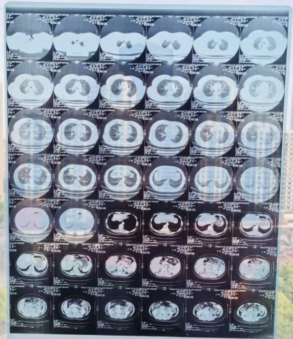 為什麼我帶來的外院CT膠片沒用？