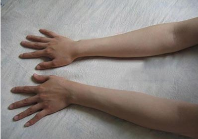 手部無力,上肢萎縮,手掌呈爪狀?醫生提醒:警惕“平山病” 手部無力,上肢萎縮,手掌呈爪狀?醫生提醒:警惕“平山病”