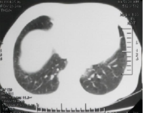 經常咳嗽誤以為是感冒,卻是肺結節,中藥調理祛風化痰、清肺止咳 經常咳嗽誤以為是感冒,卻是肺結節,中藥調理祛風化痰、清肺止咳