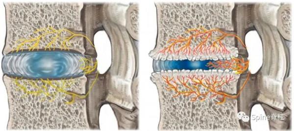椎間盤源性腰痛 (discogenic low back pain) 椎間盤源性腰痛 (discogenic low back pain)
