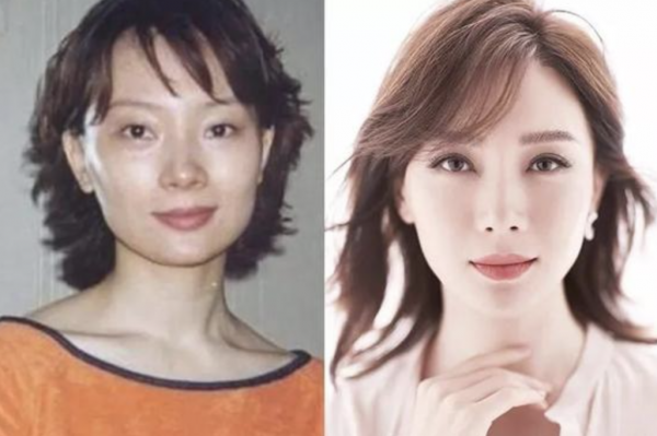 臉僵如石、腫成發麵饅頭，這7位女星動臉後變“災難現場”