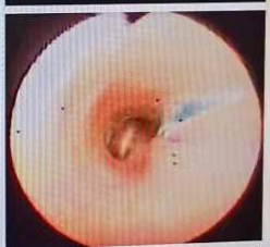 寶寶肺炎反覆發作,一查,氣管裡竟有一個洞 寶寶肺炎反覆發作,一查,氣管裡竟有一個洞