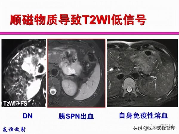 臨床MRI訊號分析基礎：常規序列及DWI序列
