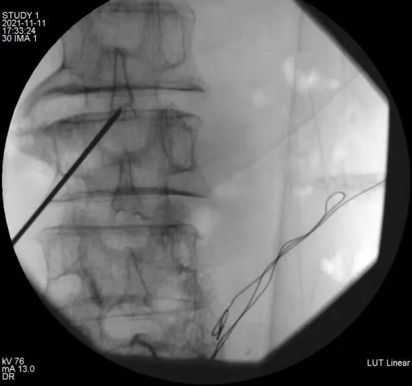 晚期癌痛治療利器：鞘內鎮痛泵植入術
