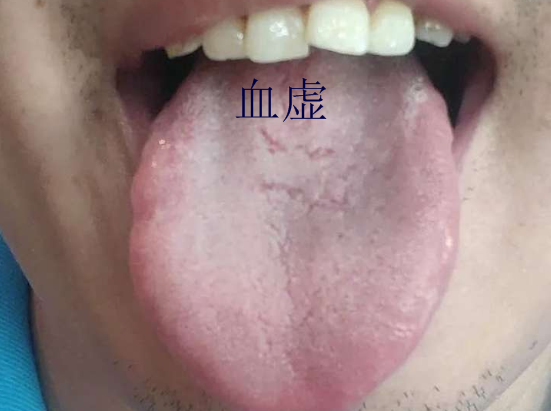 舌頭有裂紋就是陰虛嗎?教你形象地認識四種裂紋舌,十種舌象 舌頭有裂紋就是陰虛嗎?教你形象地認識四種裂紋舌,十種舌象