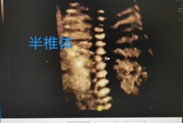 你也能看懂的胎兒畸形——病例分享 你也能看懂的胎兒畸形——病例分享