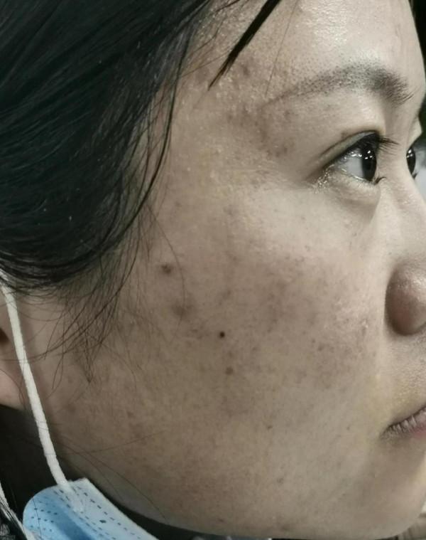 吐血三年“戰痘”，停止在臉上折騰以後，面板再也沒長過痘