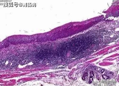 嗓子幹癢、有異物感&period;&period;&period;當成咽炎，差點要命