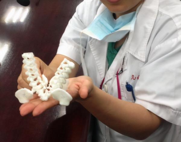 連體兒分離手術難度有多高？江西女嬰臀部相連，唯一的肛門咋分？